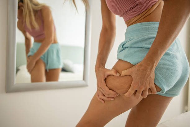 bienfaits de la pressothérapie et cellulite