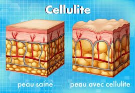 cellulite