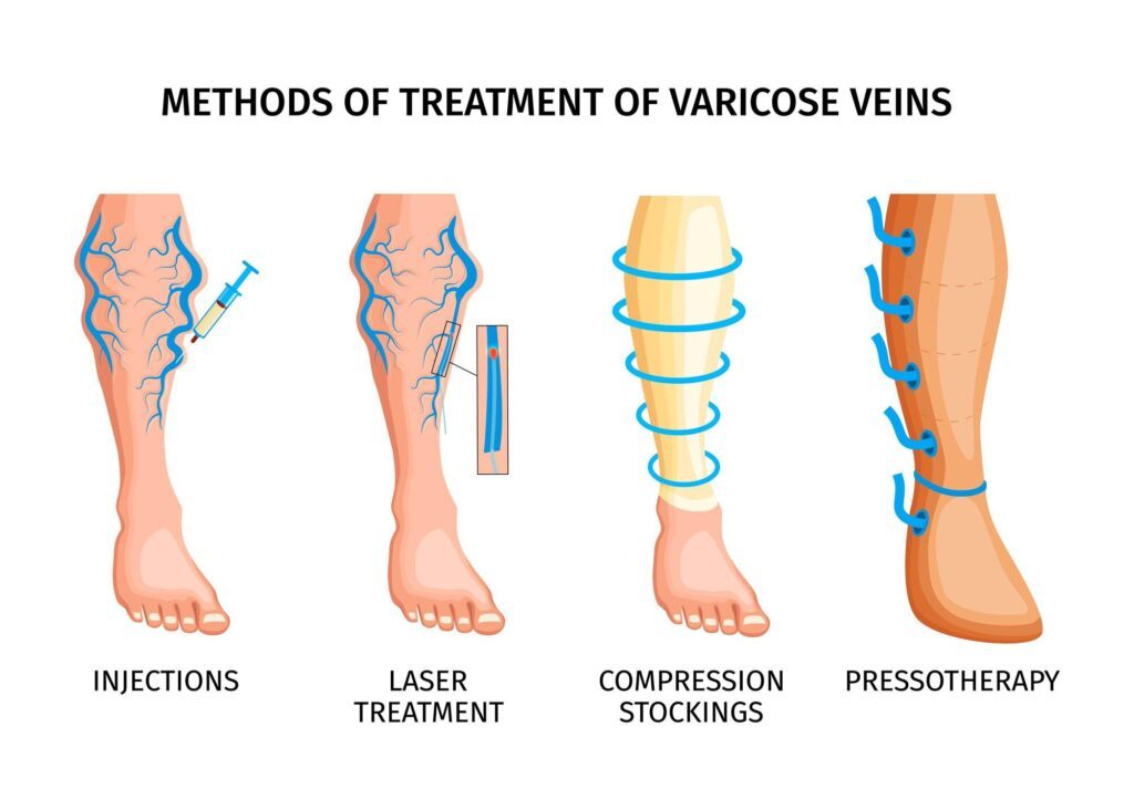 pressothérapie et varices